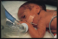 Premature baby with respiratory distress syndrome