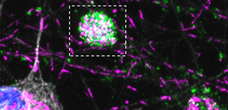 Purple mitochondria and green autophagosomes appear as lines and blotches against a black background. A large purple, green, and white ball representing swelling in the axon appears in the center and is outlined by a white dashed line. The neuron cell body is visible in the lower left.