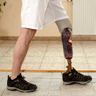 Man with prosthetic in rehabilitation