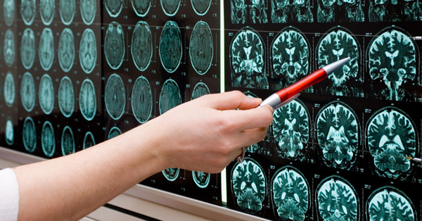 Person holding pen points at brain scans displayed on a light box on the wall.