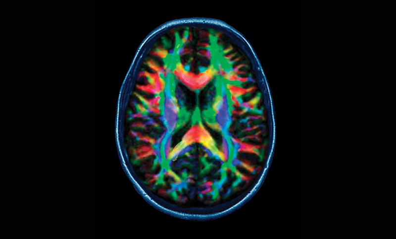 Color-coded brain scan.