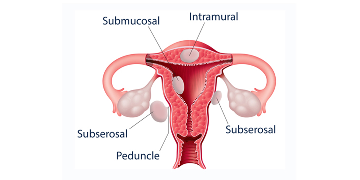 Different types of uterine fibroids shown in various locations on the uterus. Intramural, subserosal, and submucosal fibroids and a peduncle are labeled.