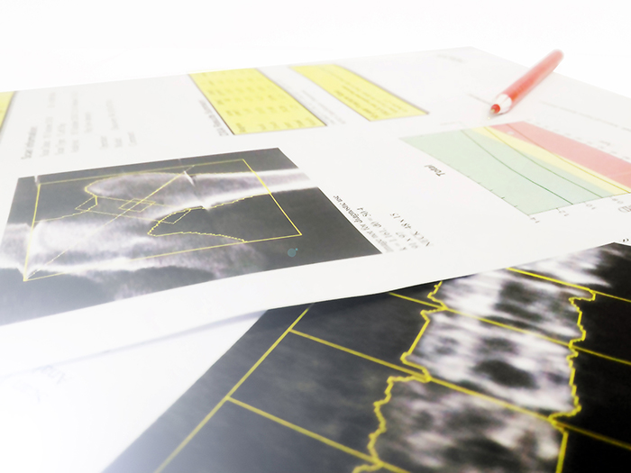 Printed copies of bone scan images on a desk top.