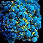 Immune cell with numerous human immune deficiency viruses on its surface.