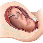 Cutaway graphic of the fetus in the womb entering the birth canal