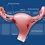 Graphic of female reproductive organs with endometriosis lesions.