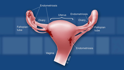 Inova Fairfax Hospital - Did you know that 10-15% of women ages 15-44 are  diagnosed with endometriosis annually? Women with endometriosis develop  tissue outside of the uterus that looks and acts like