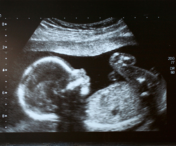 Black and white sonogram of a fetus. 