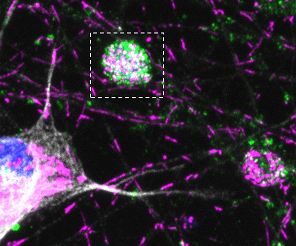 Purple mitochondria and green autophagosomes appear as lines and blotches against a black background. A large purple, green, and white ball representing swelling in the axon appears in the center and is outlined by a white dashed line. The neuron cell body is visible in the lower left. 