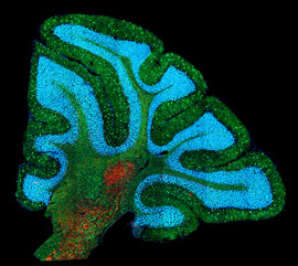 Niemann-Pick Disease Type C Archives - The Children's Inn at NIH