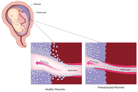 Comparison of healthy placental cells and Preeclampsia placental cells