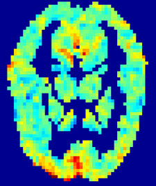 An fMRI image of brain activity after a volunteer read and thought about the word 'love'.