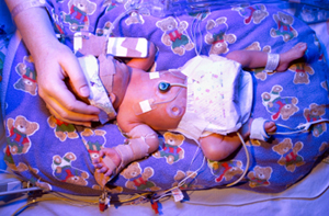 Premature baby boy undergoing phototherapy with ultra violet lighting